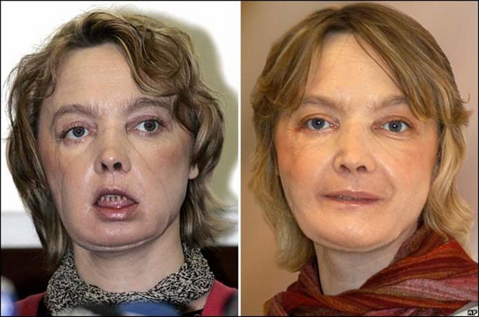Isabelle Dinoire after receiving the world's first partial face transplant [2005] Source: AP